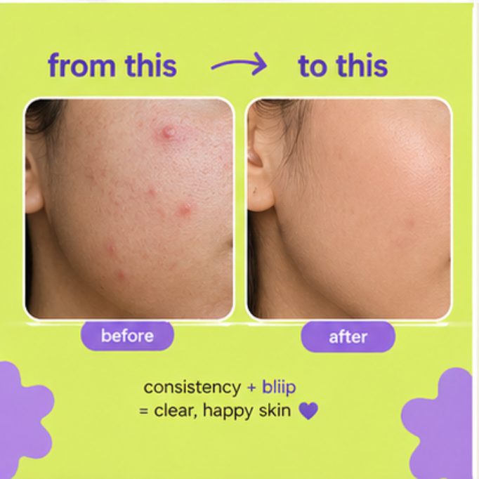 PIMPLE PATCHES